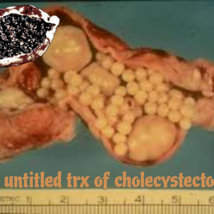 4 untilted tracks of cholecystectomy