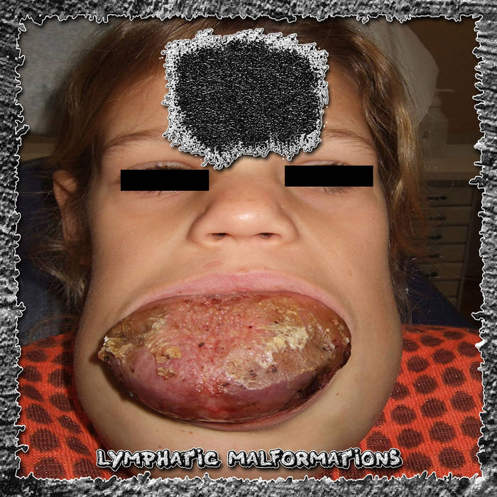 Lymphatic Malformations (Compilation)