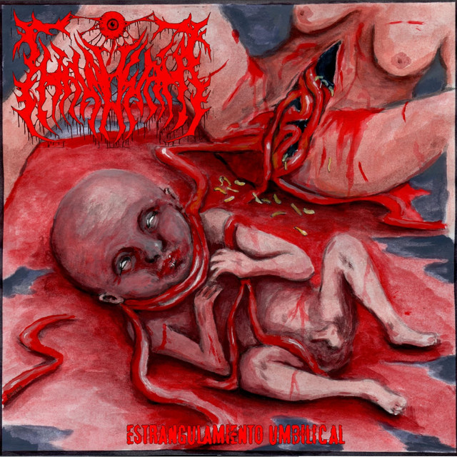 Estrangulamiento Umbilical